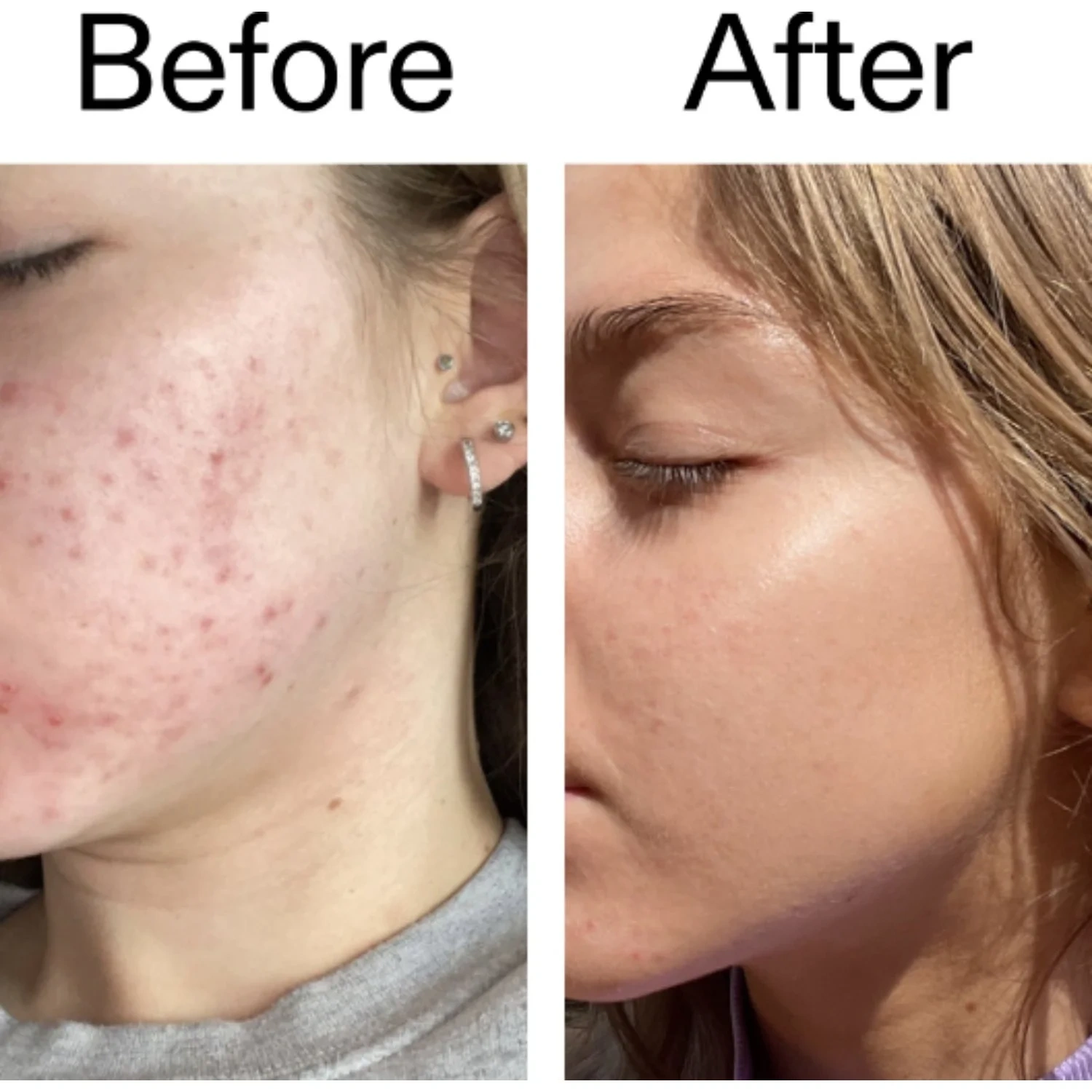 The Inkey List Beta Hydroxy Acid Serum 30 ml
