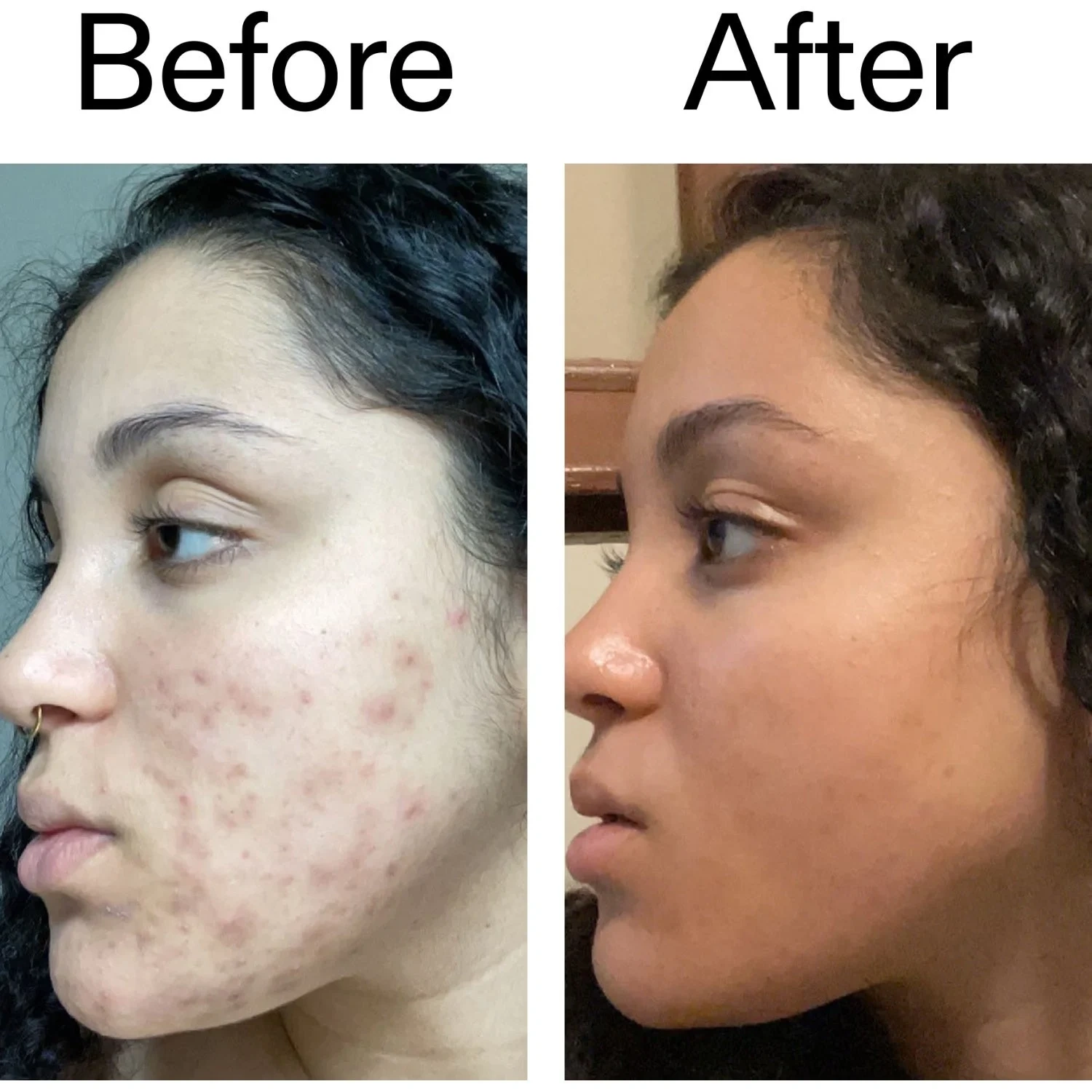 Tranexamic Acid Serum