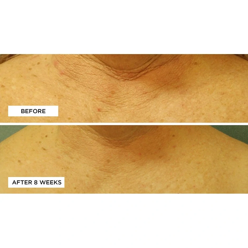 Perricone MD Cold Plasma+ Neck & Chest SPF 25
