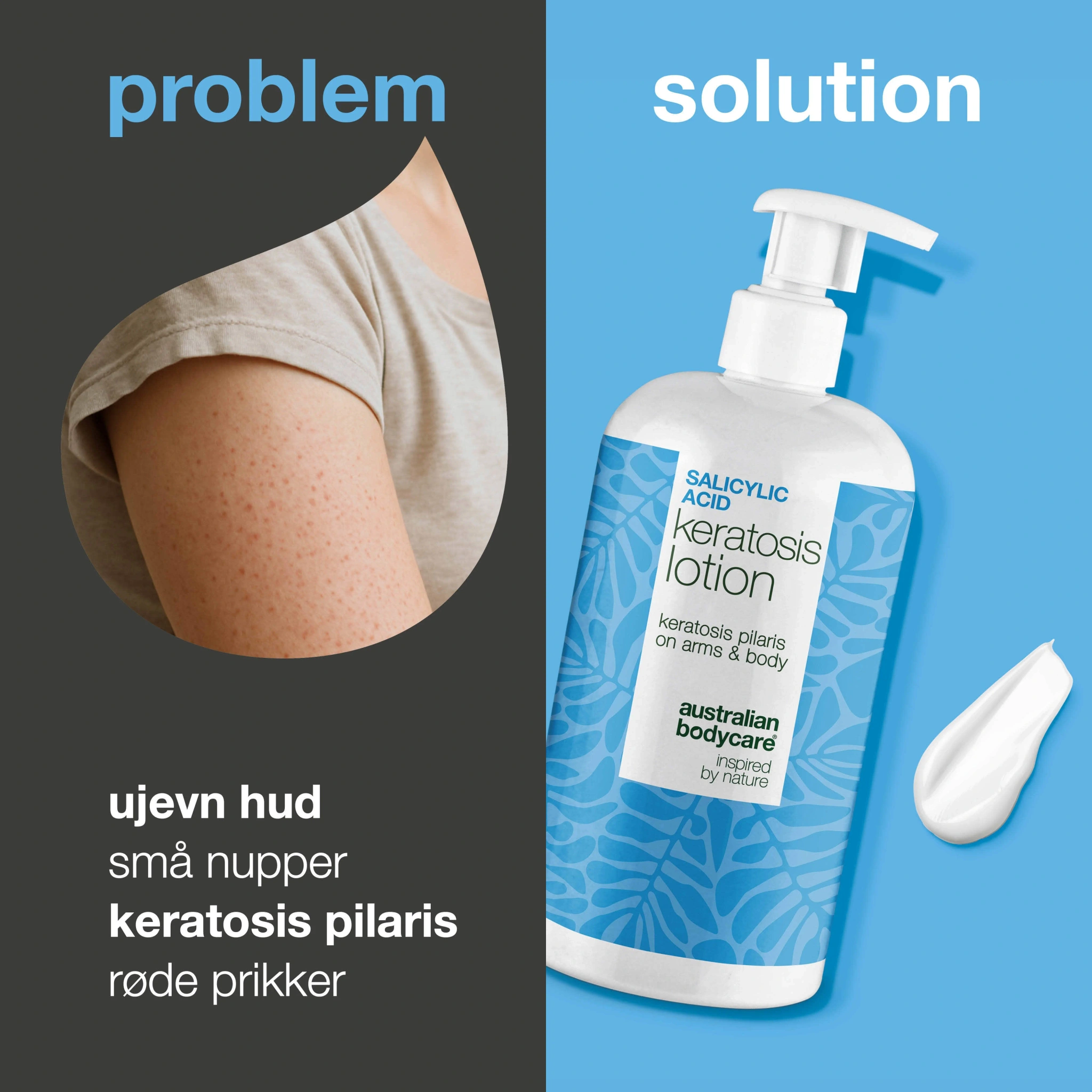 Keratosis Pilaris Bodylotion