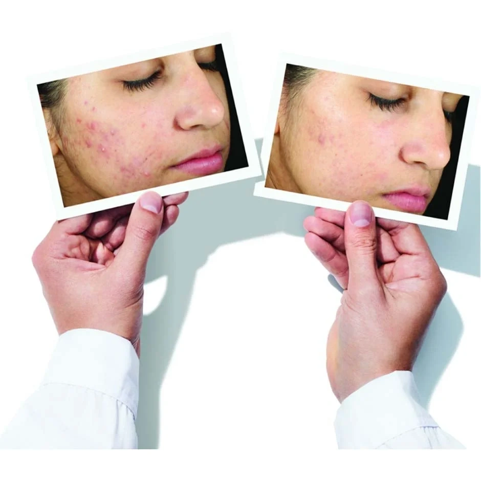 Murad Invisiscar Resurfacing Treatment 30 ml