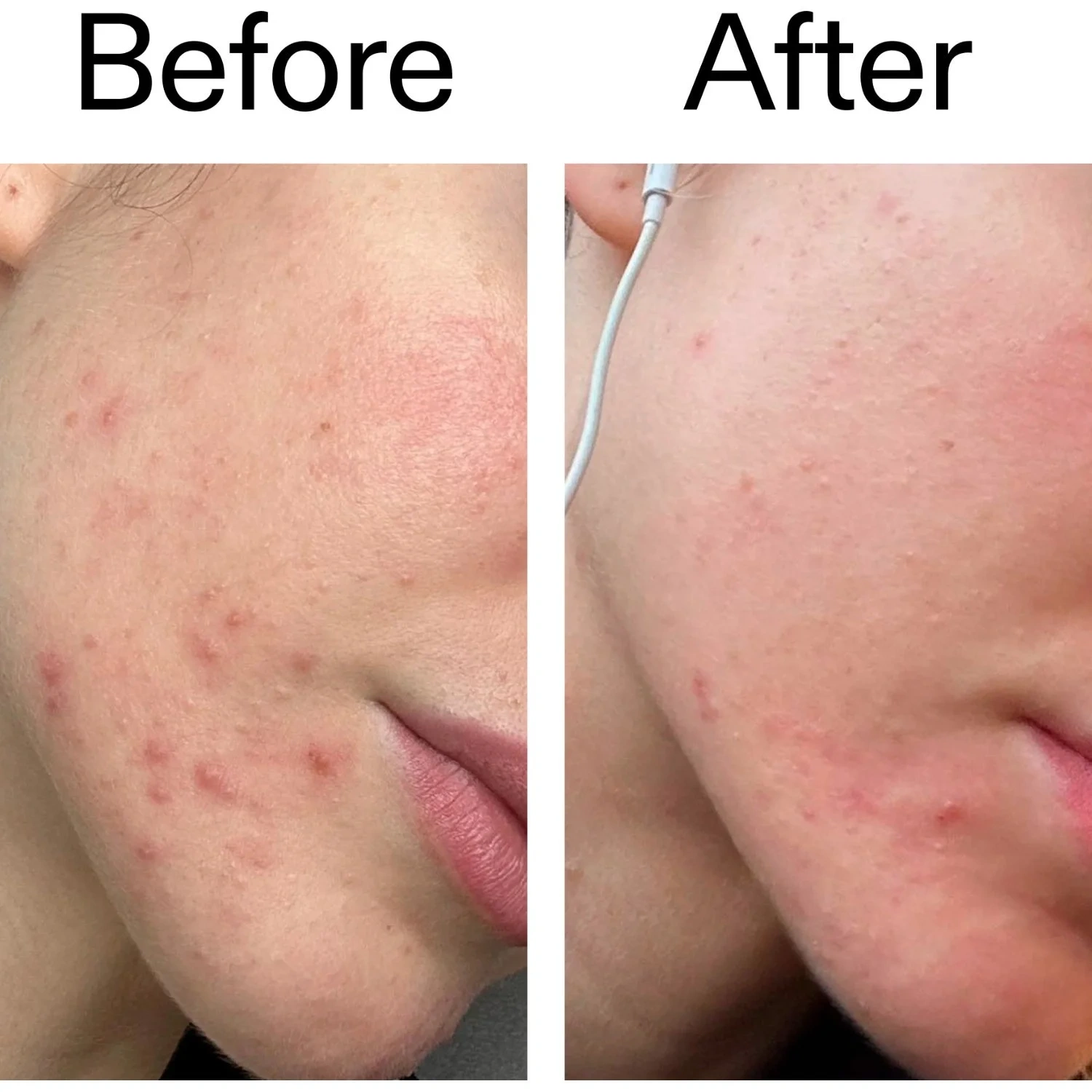 The Inkey List Blemish Moisturizer 50 ml