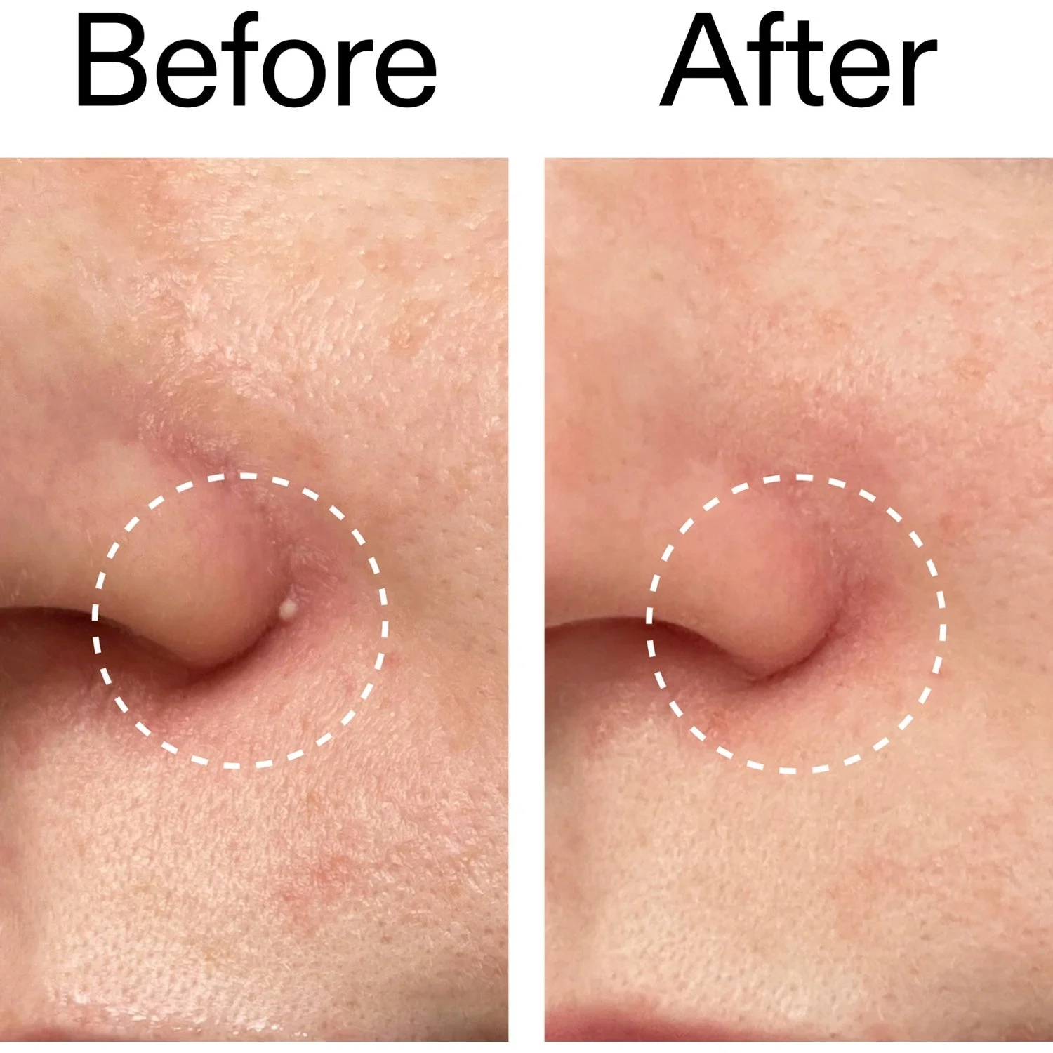 The INKEY List Hydrocolloid Pimple Patches