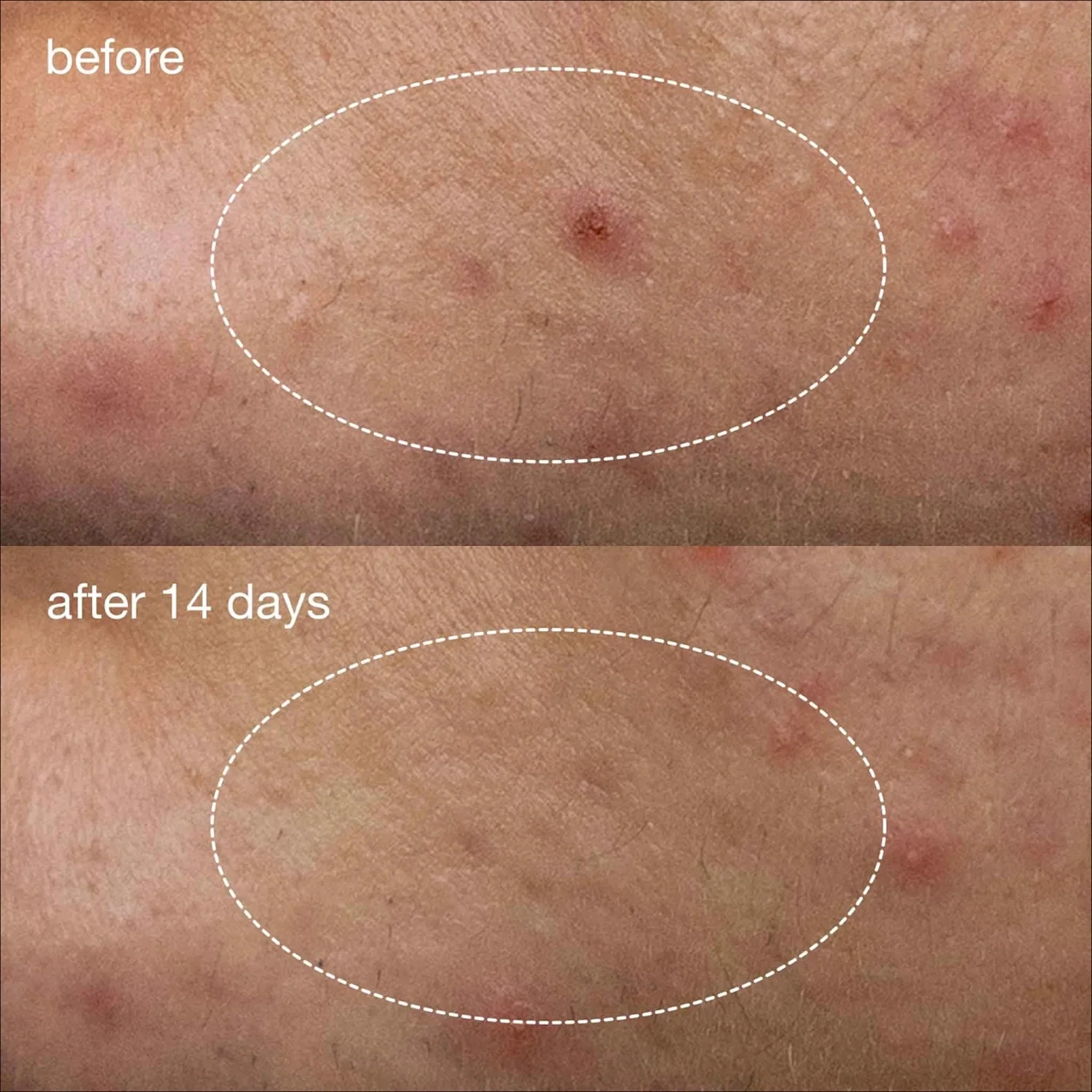 Dermalogica Deep Acne Liquid Patch