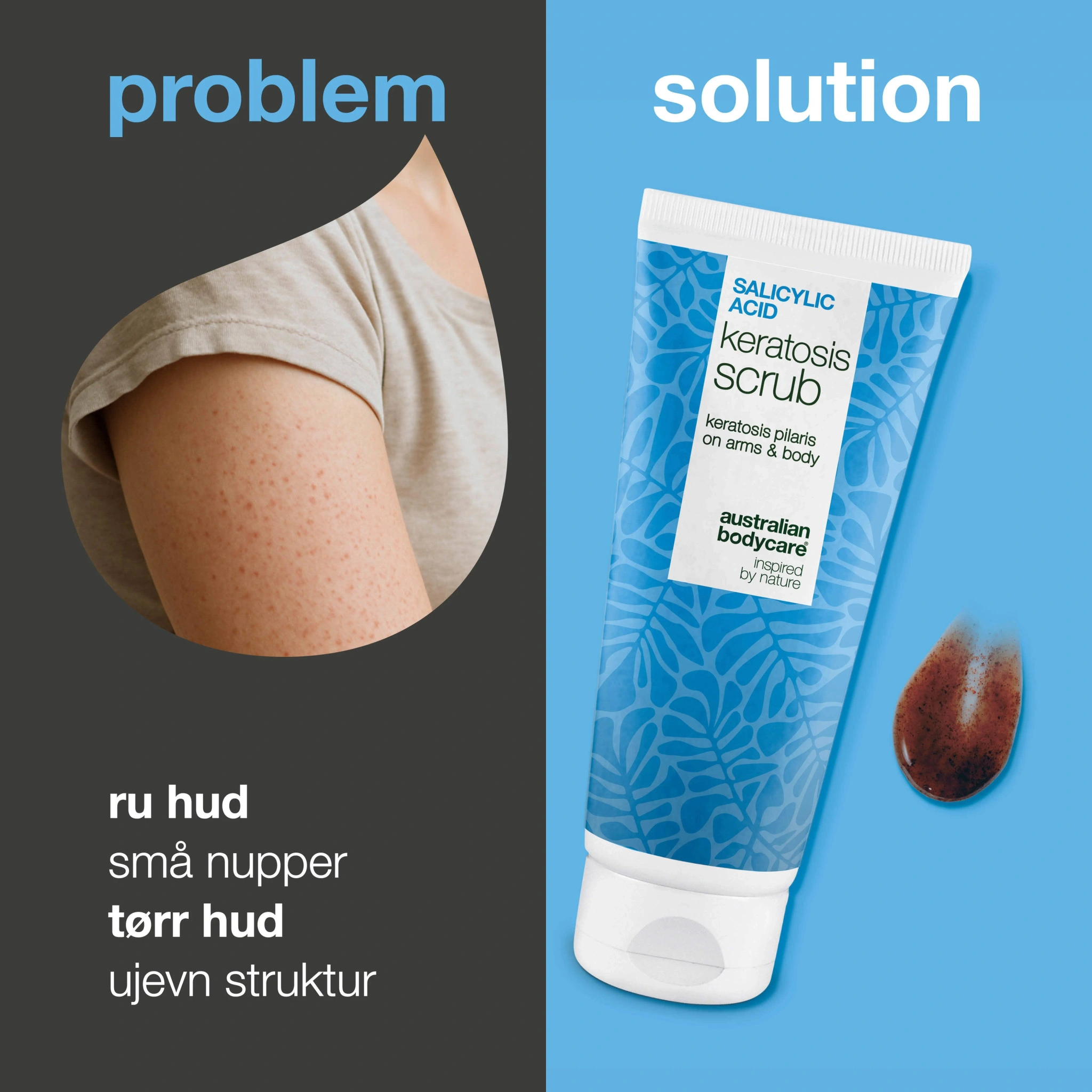 Keratosis Pilaris kroppsskrubb