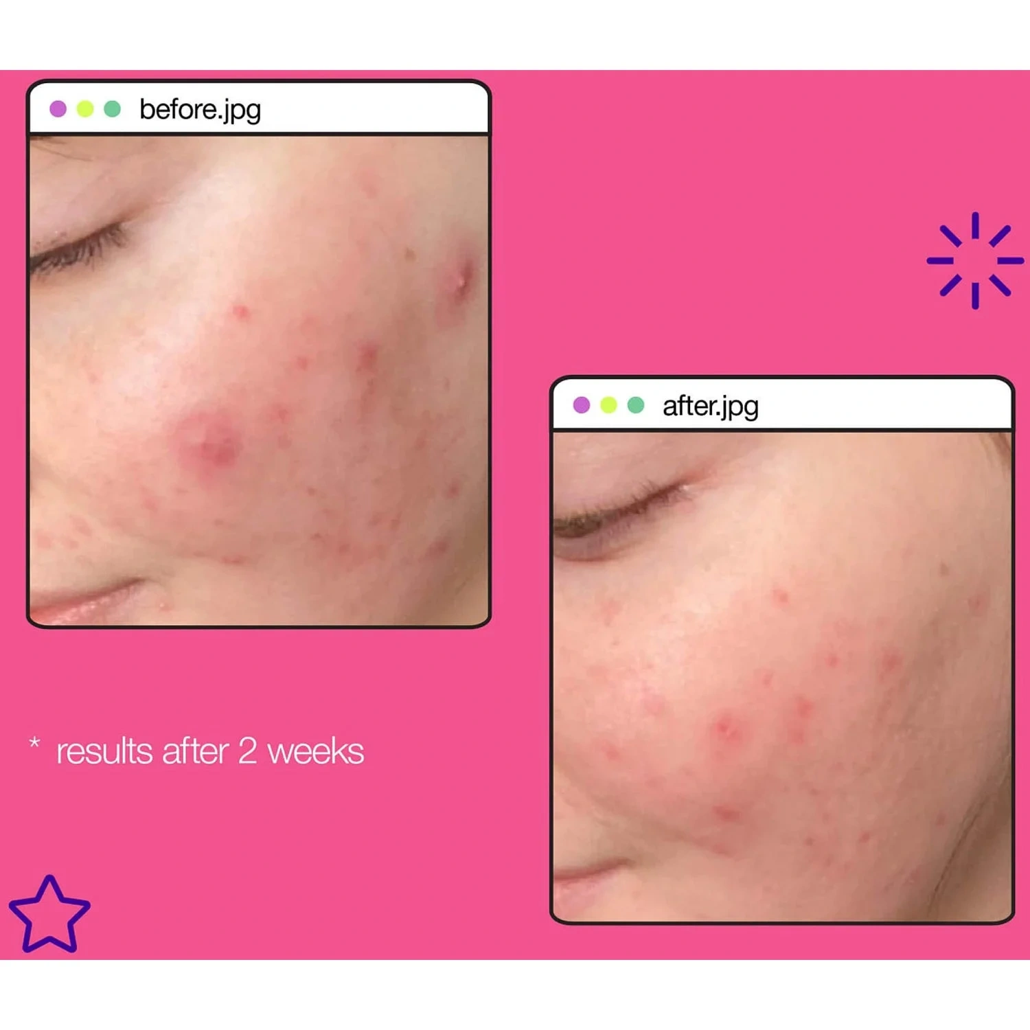 Dermalogica Breakout Clearing Liquid Peel