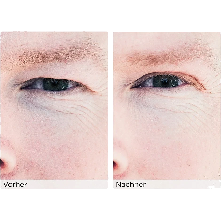 Wonderstripes The Instant Eye Lift Without Surgery